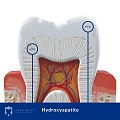 Hydroxyapatite