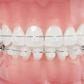 Braces