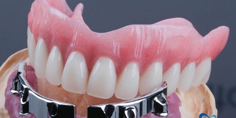 Dental implant prices