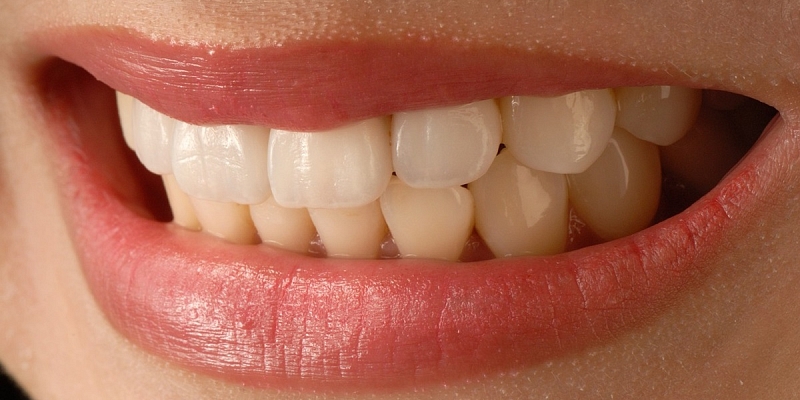 Veneers