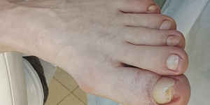 Ingrown nail correction
