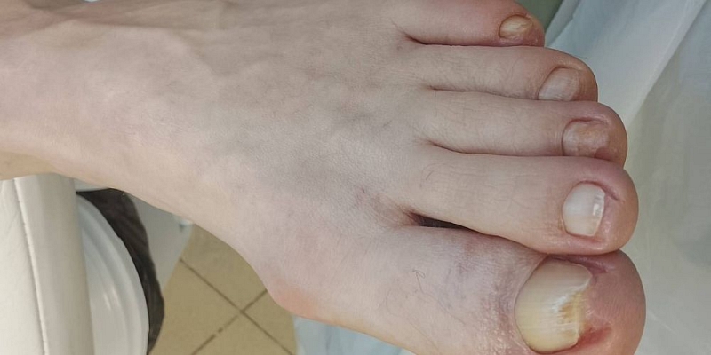 Ingrown nail correction