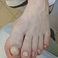 Ingrown nails
