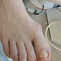 Nail fungus treatment