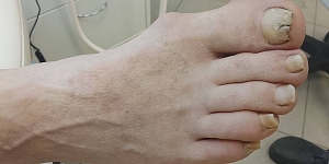 Foot care