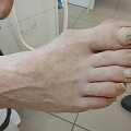 Foot care