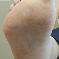 Diabetic foot care
