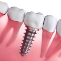 Dental implants